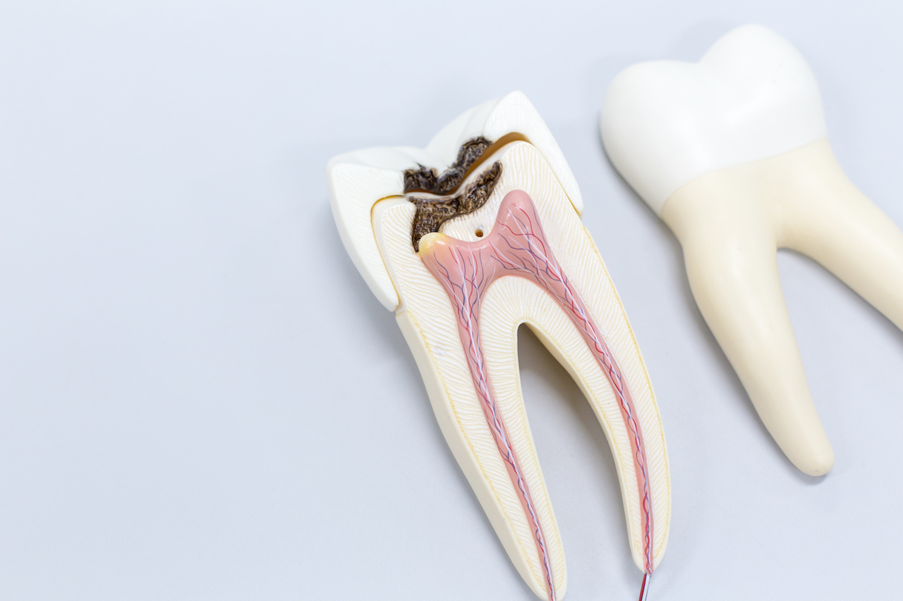 endodoncia en Carabanchel - diente por dentro