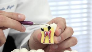 endodoncia en carabanchel - modelo de diente