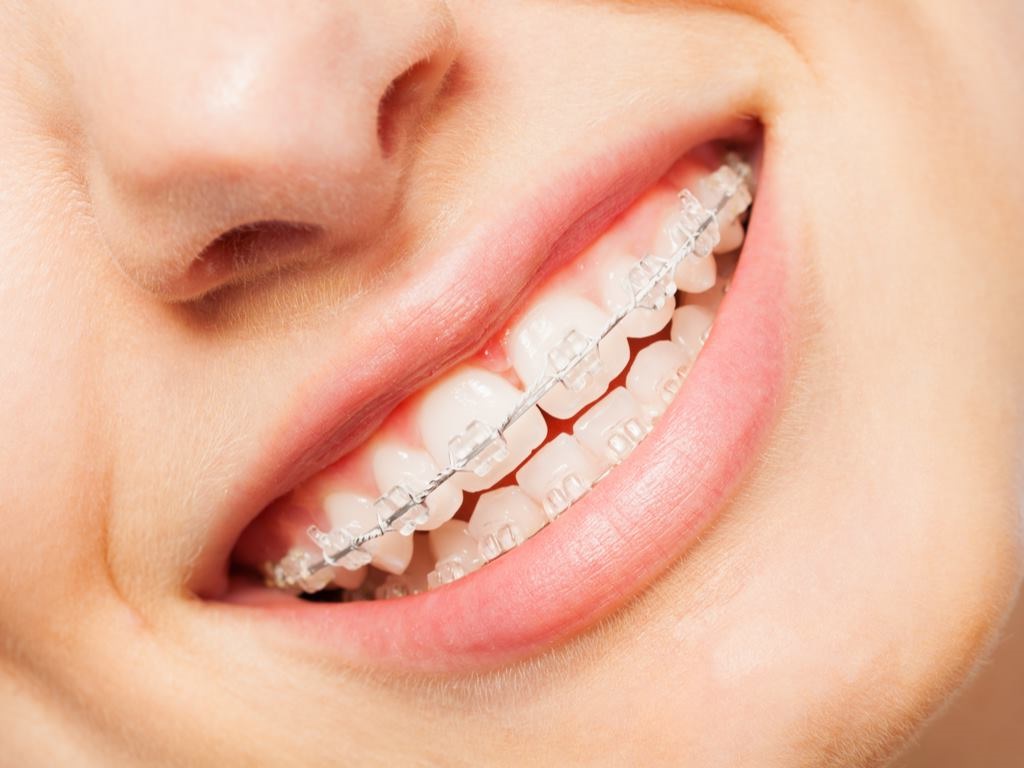 ortodoncia en Carabanchel - brackets zafiro