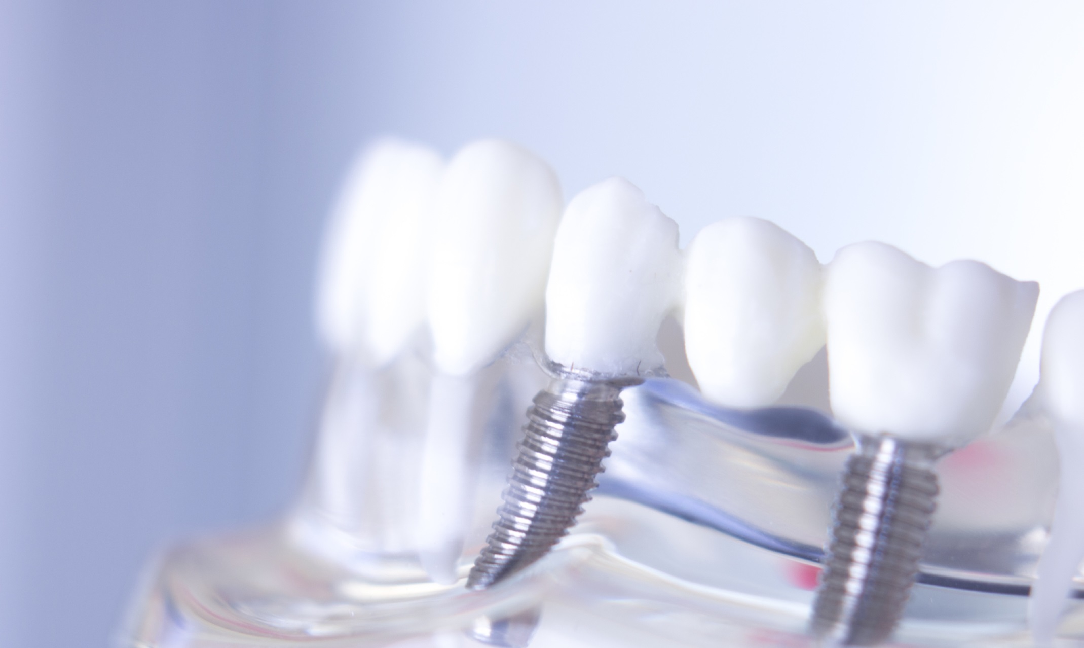 protesis dental en carabanchel - dientes