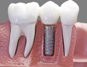 implantes dentales en carabanchel - modelo