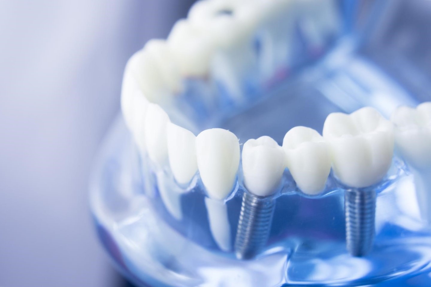 implantes dentales en Vista Alegre - azul