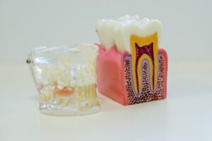 Implantes dentales en Carabanchel - maqueta