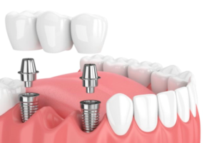 implantes dentales en carabanchel - tornillo