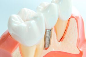 implantología dental en Carabanchel - dientes con tornillo