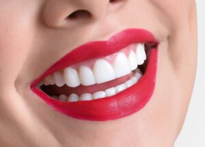 odontología estética en Carabanchel - labios rojos