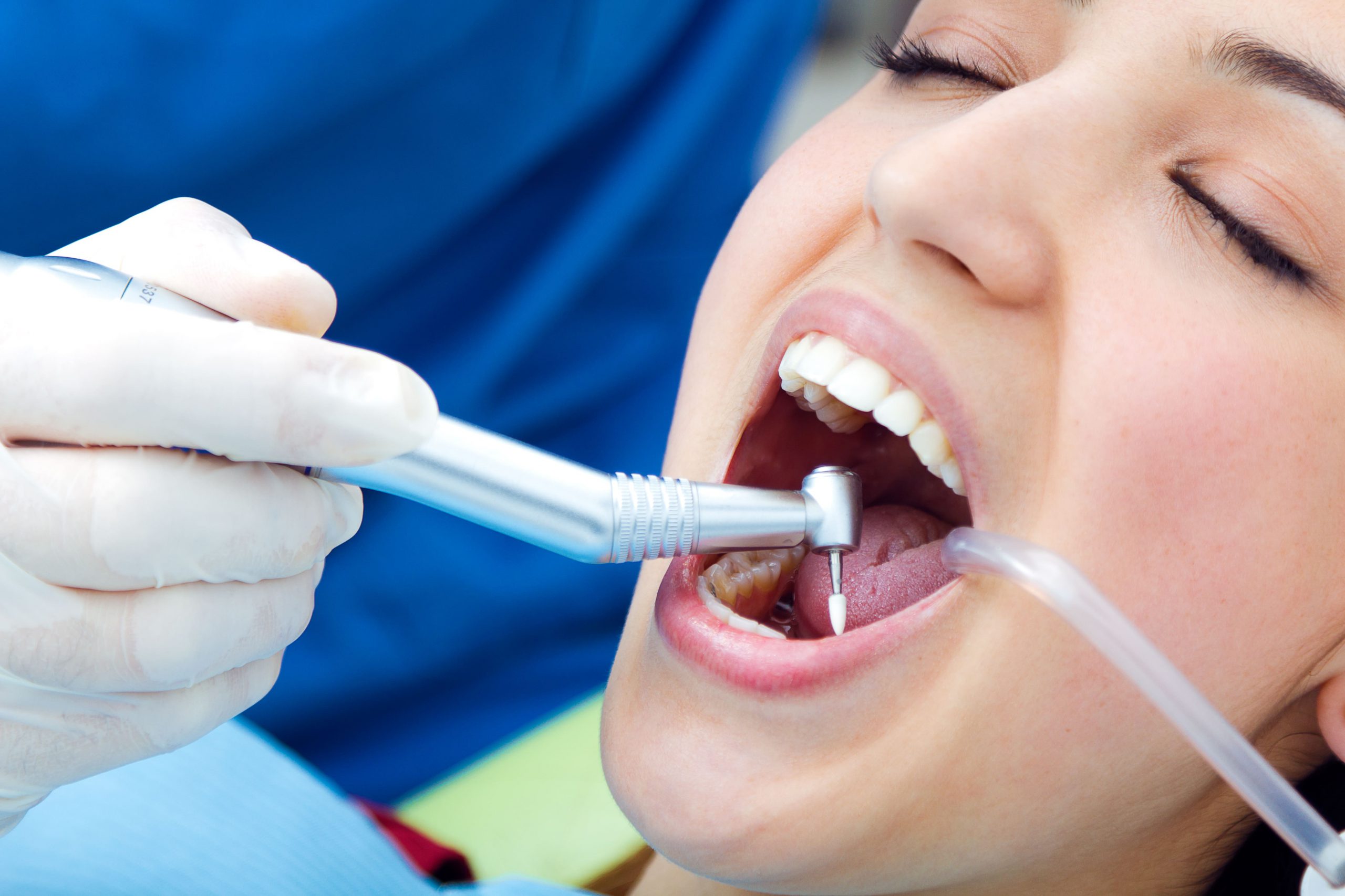 dentista en carabanchel - Limpieza dental