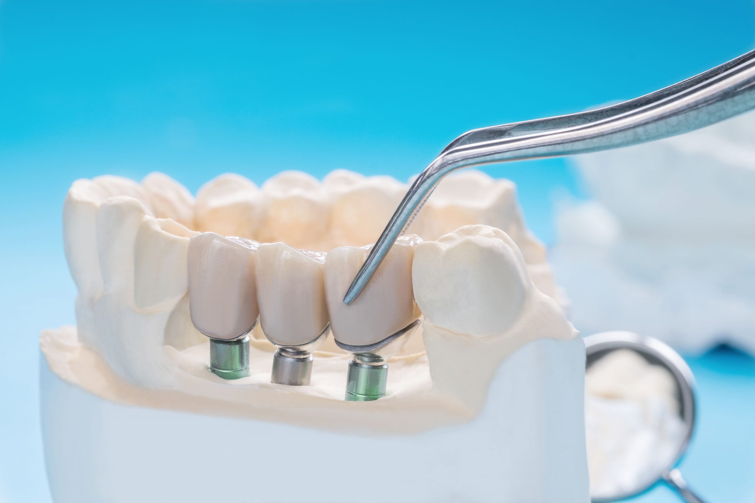 implantes dentales en carabanchel - diseño