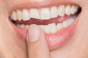 mejor dentista en Carabanchel - fractura dental