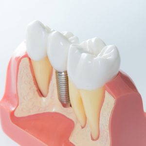 clínica dental Carabanchel - mejora de sonrisa