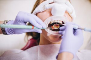 Odontología estética en vista alegre - limpieza